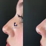 Le 2 peggiori complicanze del Rinofiller